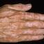5. Vitiligo Spots Pictures
