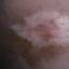 6. Vitiligo Spots Pictures