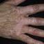 9. Vitiligo Spots Pictures