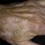 23. Vitiligo in White Person Pictures