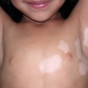 Vitiligo in Children
