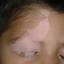 2. Vitiligo in Children Pictures