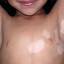 3. Vitiligo in Children Pictures