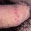 21. Herpes 2 Pictures