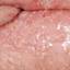 34. Herpes 2 Pictures
