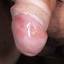 39. Herpes 2 Pictures