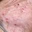 5. Herpes 2 Pictures