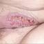 6. Herpes 2 Pictures