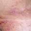 8. Herpes 2 Pictures
