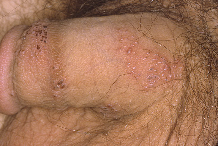 Herpes simplex virus type 2 is one of the two types of herpes viruses; it m...