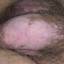 2. Vitiligo on the Penis Pictures