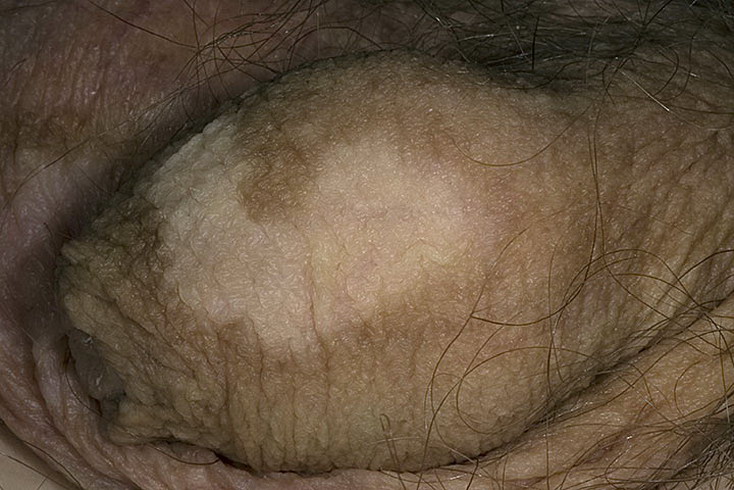 Vitiligo of the penis usually appears... 