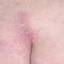 2. What does Genital Herpes Look Like Pictures