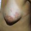 24. What does Genital Herpes Look Like Pictures