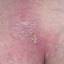 3. What does Genital Herpes Look Like Pictures