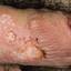30. What does Genital Herpes Look Like Pictures
