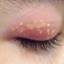 1. Eye Herpes Pictures