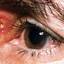 13. Eye Herpes Pictures