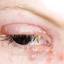 4. Eye Herpes Pictures