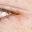 6. Eye Herpes Pictures