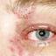 9. Eye Herpes Pictures