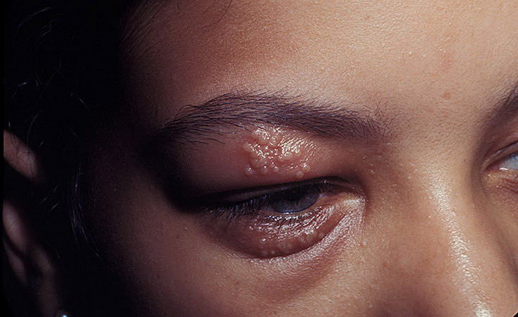 Eye Herpes Pictures – 14 Photos & Images / illnessee.com