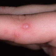 Herpes on Fingers