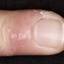 1. Herpes on Fingers Pictures