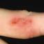 10. Herpes on Fingers Pictures
