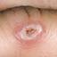 11. Herpes on Fingers Pictures