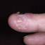 15. Herpes on Fingers Pictures