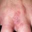 24. Herpes on Fingers Pictures