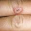 4. Herpes on Fingers Pictures