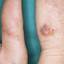 5. Herpes on Fingers Pictures