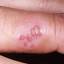 7. Herpes on Fingers Pictures
