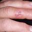 9. Herpes on Fingers Pictures