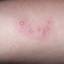 4. Herpes Initial Stage Pictures