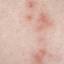 6. Herpes Initial Stage Pictures