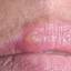 7. Herpes Initial Stage Pictures