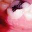 4. Herpes on Gums Pictures