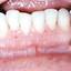 5. Herpes on Gums Pictures