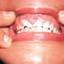 8. Herpes on Gums Pictures