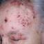4. Herpes on Head Pictures