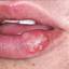 1. Herpes on Lip Pictures