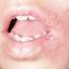 10. Herpes on Lip Pictures