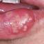 11. Herpes on Lip Pictures