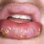 12. Herpes on Lip Pictures