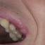 17. Herpes on Lip Pictures