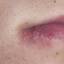 18. Herpes on Lip Pictures