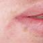 19. Herpes on Lip Pictures